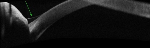 Figure 1 Marginal tear strip as seen by AS-SD-OCT.