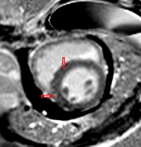 Figure 5 Streaky late gadolium mid-myocardial enhancement in the septal region (red arrows).