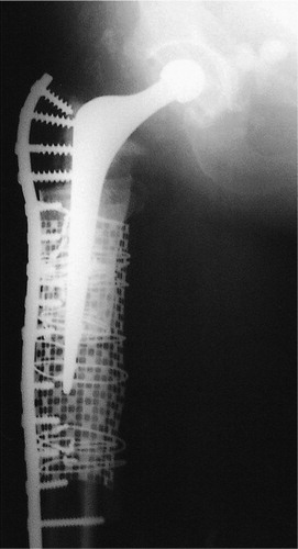 Figure 4. Long DCP plate. The plate was used for the treatment of a Vancouver type B2 fracture along with impaction grafting revision of the stem.