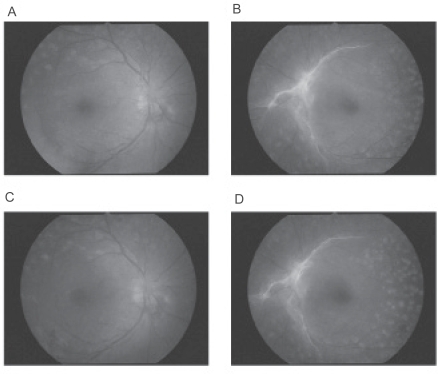 Figure 1 Fundus photographs before and after pioglitazone treatment. A and B: 4 months before pioglitazone treatment, macula edema is not present in either eye (A shows the right eye, B the left eye). C and D: during pioglitazone, DME is present in both eyes but it is difficult to detect in fundus photographs because the DME is very diffuse (C shows the right eye, D the left eye).