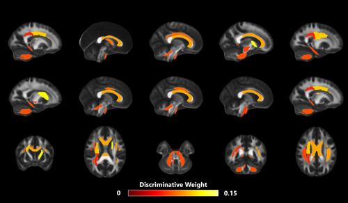 Figure 5 The discriminative WM tracts. To aid visualization, the image was thickened using the “tbss_fill” command.