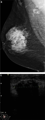 Figure 1 A 51-year-old female presented with hard right breast after suffering from right breast trauma 2 months previously. (A and B) Craniocaudal and mediolateral mammogram of the right breast revealed a dense breast with architectural distortion noted at upper outer quadrant (more evident on craniocaudal view). (C) Ultrasound revealed an ill-defined irregular hypoechoic mass with posterior acoustic shadowing at 9 o’clock of the right breast.