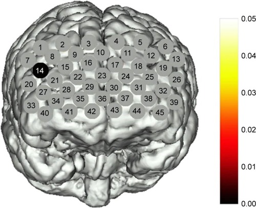 Figure 5 A map showing statistically significant lower oxy-Hb changes in BDp patients compared with BDn during the VFT.