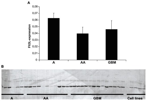 Figure 1 Expression of Flt3 receptor and ligand in astrocytic gliomas. (A) Real-time polymerase chain reaction quantification of Flt3L mRNA abundance in three diffuse astrocytomas of WHO grade II (A), six anaplastic astrocytomas of WHO grade III (AA) and 14 glioblastomas (GBM) of sufficient RNA quality for analysis. Means and standard errors of the mean are shown. (B) Silver-stained polyacrylamide gel, which identifies expression of Flt3 receptor mRNA in most diffuse astrocytomas of WHO grade II (A), most anaplastic astrocytomas of WHO grade III (AA), and glioblastomas (GBM), as well as all the glioblastoma-derived cell lines with the exception of U251MG (outermost left from the lanes representing cell lines).