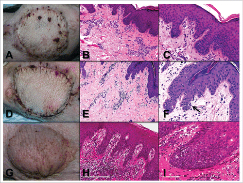 Figure 8. A) Animal A3 VCA post-surgical day 13 showing mild edema. B) Animal A3 POD 13 skin biopsy showing minimal perivascular inflammation (pc1, pa1) and C) no epidermal involvement (ei0, e0). D) Animal B3 POD 14 showing mild edema. E) Animal B3 POD 14 skin punch biopsy showing mild perivascular inflammation (pc1, pa1) but with F) epidermal apoptosis (arrow) and focal necrosis (not shown) (ei1, e2). G) Animal B1 POD 42 showing erythema. H) Animal B1 POD 42 skin biopsy showing severe perivascular inflammation (pc3, pa3) and I) lymphocytic infiltration and focal apoptosis (not shown) (ei2, e1).