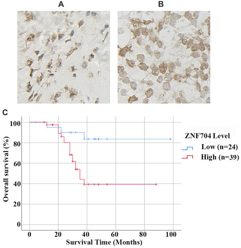 Figure 2 Prognostic value of ZNF704 in chondrosarcoma cases. (A and B) Representative immunostaining of ZNF704 were shown in human cartilage tumors. Osteochondroma with low nucleus immunostaining of ZNF704 (A). High (B) nucleus immunostaining of ZNF704 were detected in chondrosarcoma tissues. (C) Prognostic significance of ZNF704 in 63 patients with chondrosarcoma. Kaplan-Meier overall survival curves and the Log rank test of 63 cases of chondrosarcoma patients based upon the status of ZNF704 expression were conducted, and unravelled that high ZNF704 expression remarkably correlated with poor prognosis (P=0.01).