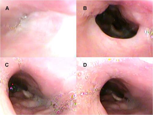 Figure 4 Drug-induced sleep endoscopy results at the velar level: head rotation to the left. Head rotation without intermittent negative airway pressure (iNAP) therapy during (A) inspiration and (B) expiration. Head rotation with iNAP therapy during (C) inspiration and (D) expiration.
