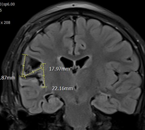 Figure 2 Post-operative fluid-attenuated inversion recovery magnetic resonance image showing increased signal intensity in the right insula, which was the epileptogenic region.