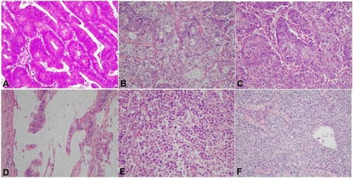 Figure 1 (A) Pathology image of well-differentiated adenocarcinoma; (B) Pathology image of moderately differentiated adenocarcinoma; (C) Pathology image of poorly differentiated adenocarcinoma; (D) Pathology image of mucinous adenocarcinoma; (E) Pathology image of signet-ring cell carcinoma; (F) Pathology image of squamous cell carcinoma. (×200).