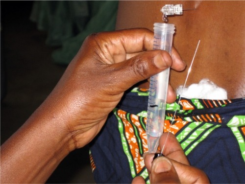 Figure 3 Lumbar puncture and cerebrospinal fluid (CSF) sample collection in a village healthcare facility. The patient gave her informed consent to be photographed and for the eventual publication of the picture.