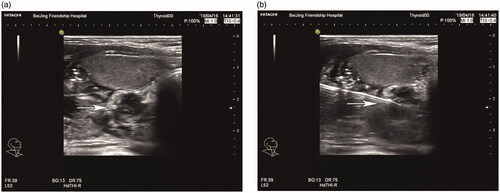 Figure 1. Parathyroid nodule presenting as a hypoechoic signal before MWA (a); the ablation needle was inserted into the parathyroid nodule under ultrasound guidance (b). MWA: microwave ablation.