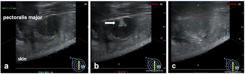Figure 1. Typical change in the gray scale of fibroadenoma on the dynamic realtime ultrasound image during HIFU treatment. (a) Before treatment, ultrasound image showed a hypoechoic breast fibroadenoma. The distance from the shallow margin of the fibroadenoma to the skin and the distance from the deep margin of the fibroadenoma to the pectoralis major were measured. (b) During HIFU, a significant gray scale changes was observed (white arrow). (c) Once the significant gray scale changed area covered the whole fibroadenoma, the procedure was terminated.
