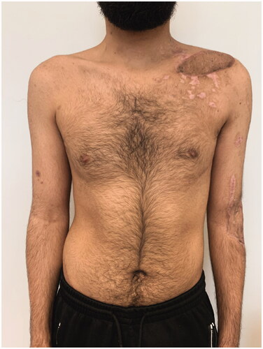 Figure 5. Postoperative result after 8 weeks: good defect coverage, inconspicuous scar and only minor impairment of the chest form can be observed.