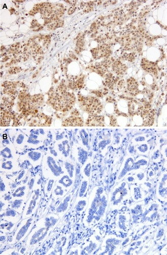 Figure 2 Immunostaining for TLE3 in preoperative breast cancer core biopsies.