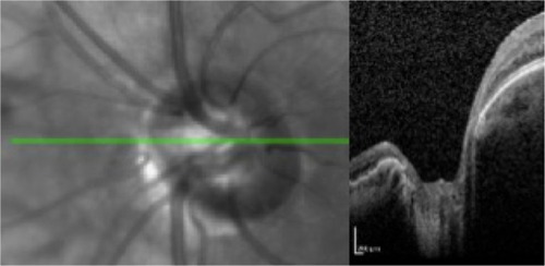 Figure 9 B-scan optical coherence tomographic image through the optic disc showing no silicone oil trapped.