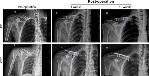 Figure 2 The representative, longitudinal chest radiographs of the clavicle fracture alone group (upper panels) and clavicle fracture and concomitant TBI group (lower panels) were collected at the time points of pre-operation, 4 and 12 weeks post operation from the same patients.