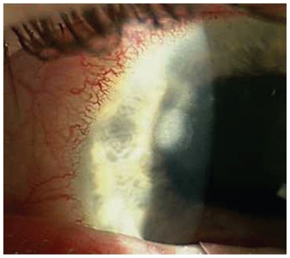 Figure 3 Multiple corneal infiltrates of the right cornea.
