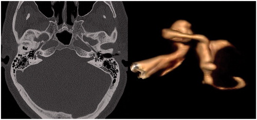 Figure 1. (A) HRCT showing bilateral cochlear otospongiosis and so-called halo effect (arrows). (B) 3 D reconstruction of MRI images shows complete obliteration of the basal turn of the scala tympani, but patent lumen of the scala vestibuli. That finding was confirmed intraoperatively.