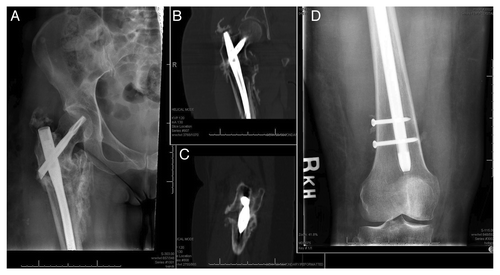 Figure 1: (A) AP Radiograph of a hypertrophic nonunion of a subtrochanteric femur fracture, eleven months following cephalomedullary rod fixation. Coronal (B) and sagittal (C) CT images of the hypertrophic nonunion. (D) AP radiograph of the knee, showing insufficient effectively-unicortical screw fixation, which led to excess implant motion at the fracture site.