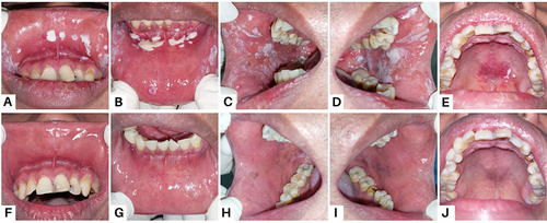 Figure 5 Intraoral condition in patient Case 5 (A–D) On the first visit, white plaques resembling curdled milk were present on the labial mucosa and buccal mucosa (E) Diffuse erythema of the hard palate (F–J) After four weeks, the lesions disappeared.
