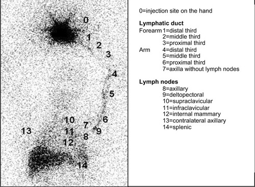 Figure 1 Lymphoscintigraphy including the area from the hand to the abdominal region.