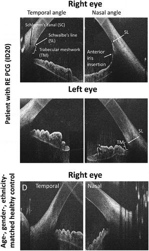 Figure 3. Horizontal high-resolution HH-OCT images of the temporal and nasal irido-corneal angles in a patient with PCG in the right eye and a healthy age-, gender- and ethnicity-matched control. The image of the right affected eye of the patient shows abnormal anterior iris insertion in the nasal angle with the iris rout inserting at Schwalbe line (SL) covering the trabecular meshwork (TM). Normal configuration with a visible trabecular meshwork in the temporal angle of the affected eye, in the non-affected eye as well as in the control subject. Reprinted with permission from [Citation61], licensed under https://creativecommons.org/licenses/by/4.0/.