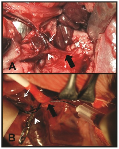 Figure 1 (A) Midline laparotomy. Retraction of the spleen and stomach. Celiac trunk (thick black arrow), hepatic artery (thin white arrow), and gastroduodenal artery (white arrowhead). (B) Exposure of the celiak trunk. Direct puncture of the artery with a 30G needle. Celiac trunk (thick black arrow) and hepatic artery (thin white arrow). The gastroduodenal artery appears clamped by a removable surgical staple (white arrowhead).