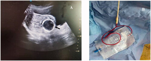 Figure 2. A. Transabdominal ultrasound image (sagittal view) of Foley catheter balloon (black arrow) inflated with 20 ml fluid and used for hemostasis by compression at the time of CSP treatment. B. The end of Foley catheter was connected with a drainage bag to calculate the amount of bleeding.