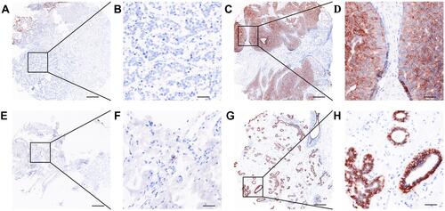 Figure 1 IHC staining of TROP2 in BC tissues on tissue microarray sections. Positive staining was observed as dark brown color. (A and E) Low expression of TROP2 in BC tissues and matched adjacent tissues, respectively. (C and G) High expression of TROP2 in BC tissues and matched adjacent tissues, respectively. (A), (C), (E) and (G) were scanned by Vectra Polaris Pathology Imaging System at ×10 magnification (bar, 500 μm), (B), (D), (F) and (H) were shown at original × 50 magnification (bar, 100 μm).