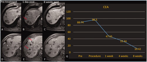 Figure 4. Histotripsy of CRLM with decreasing CEA. Patient with colorectal cancer with involution of the non-treated tumors. Treated tumor is not shown. Axial contrast-enhanced MR images obtained at 2 different slices; pretreatment (A, D), 1-day post treatment (B, E), and 8-week post-treatment (C, F). Red arrows (B, E) denote tumors with increased peripheral enhancement (reaction around off-target tumors that could indicate a systemic anti-tumor response) compared with pretreatment images. (G) Graph of CEA over the course of the trial for this patient.