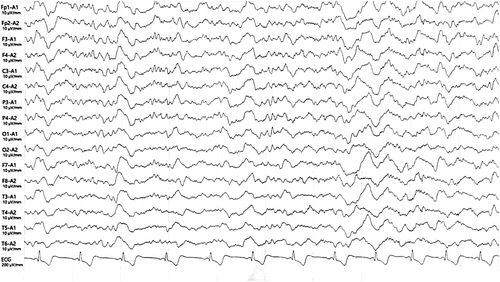 Figure 5. EEG results of the patient after 2 months of TCM treatments. EEG showed diffuse slow waves without sharp waves.