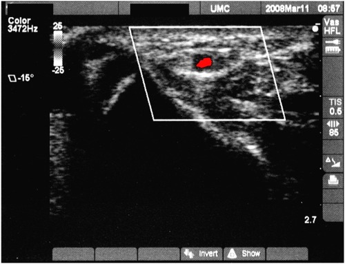 Figure 1 Ultrasound view of radial artery.