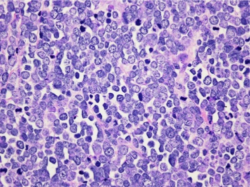Figure 2 Hematoxylin and eosin slide 40×10, Merkel cell carcinoma.
