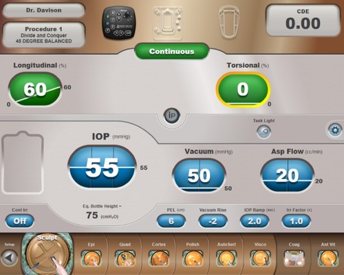 Figure 5 The machine screen display of the Sculpt Setting (Sculpt Procedure Step Button enlarged in the procedure step toolbar) shows low fixed values for vacuum and aspiration flow and linear control of continuous longitudinal tip motion.