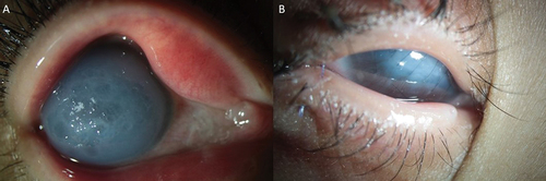 Figure 6. (a, b): a: External digital photograph of the right eye showing diffuse corneal edema; b: External photograph of the eye on the first postoperative day. (The patient was not able to cooperative for slit-lamp photographs.).