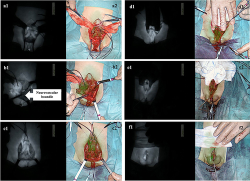 Figure 2 Tissue perfusion assessment using the EleVision IR system (Medtronic Ltd) to detect 0.15 mg/kg of ICG intraoperatively administered following i) the mobilization of the bladder plate and the exposure of both corpora (a1 and a2); ii) the mobilization of the left corpus (b1 and b2); the mobilization of both corpora (c1 and c2); the complete detachment of the urethral plate (d1 and d2); the approximation of the pubic symphysis (e1 and e2); the surgical reconstruction (f1 and f2).