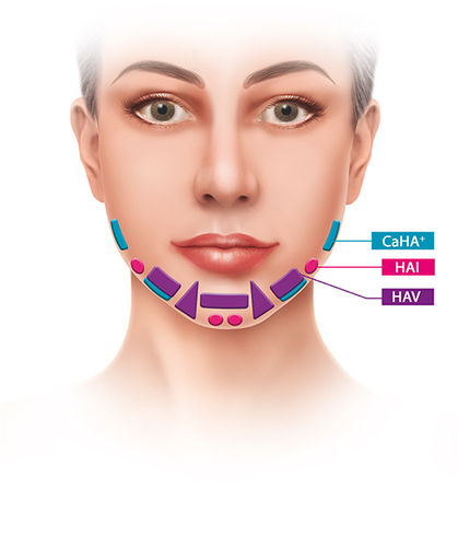 Figure 2 Possible treatment areas in the contouring plus technique (Frontal view): (Radiesse® (+); Merz North America, Inc., Raleigh, NC, USA). In purple, areas to be approached with a moldable hyaluronic acid, with balanced Gʹ hyaluronic acid (HAV; Belotero® Volume; Cohesive poly-densified matrix hyaluronic acid; Merz Pharmaceuticals GmbH, Frankfurt, Germany), whilst in red, areas in which a HA with high resistance to deformity (high Gʹ, Eʹ and Fn; HAI; Belotero® Intense; Cohesive poly-densified matrix hyaluronic acid; Merz Pharmaceuticals GmbH, Frankfurt, Germany) should be the choice. Round areas correspond to supraperiosteal plane of injection. The triangle and rectangle areas correspond to injections performed in the subcutaneous plane.