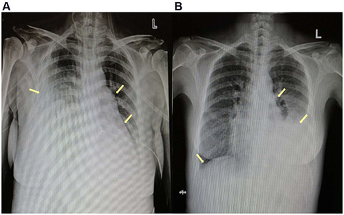 Figure 3 X-rays: (A) at the first admission: the arrows showed large pleural effusion on the right chest and small on the left, enlargement of right heart and a protruded pulmonary artery segment; (B) 5 months after discharge: the arrows showed significantly reduced pleural effusion, right heart enlargement and protruded pulmonary artery segment all improved.