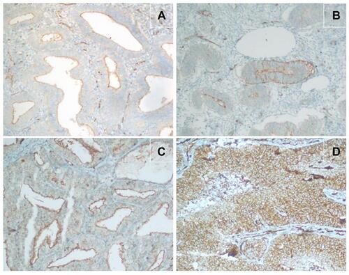 Figure 2 (A) Negative radixin expression in proliferative endometrial tissues. (B) Weak radixin expression in cases of endometrial hyperplasia without atypia. (C) Moderate radixin expression in cases of endometrial hyperplasia with atypia. (D) Severe radixin expression in endometrial cancer cases.