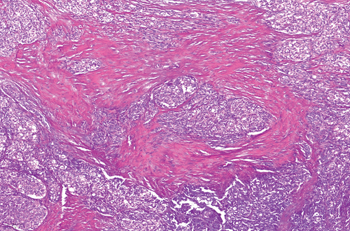 Figure 2. Histological micrograph for SMEC with high cellularity (case #1) (H&E, ×4).