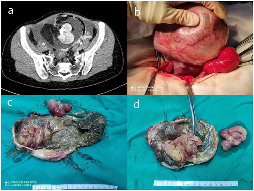 Figure 2. Intraoperative view of one patient with synchronous pseudo-Meigs’ syndrome and elevated serum CA125 level (Case 4). (a) CT scan identified an 11.5*7.5*13.1 cm solid-cystic pelvic mass and massive ascites. (b) The mass was of left ovary origin with a smooth surface and plenty of blood vessels. (c) The cutting surface of the ovarian tumor revealed a cystic-solid structure with lipids and hair. (d) The cutting surface of the solid portion was in dark red, yellowish color.