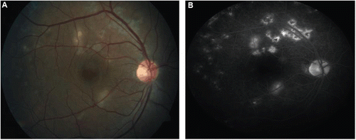 FIGURE 1  (a) First follow-up fundus image of right eye showing whitish yellow choroiditis, new lesions, and atrophic lesions along vessels. (b) Late-phase FFA image of right eye showing the fuzzy margins due to leakage from the active lesions.