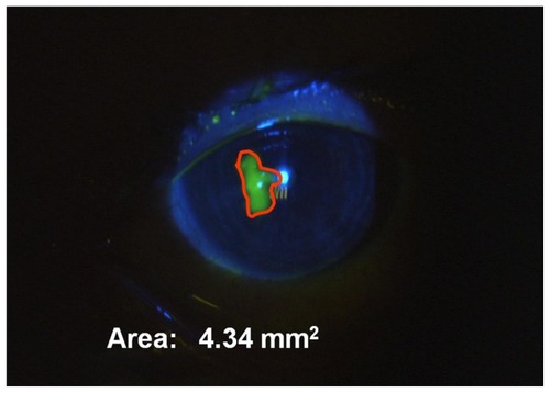 Figure 1 Measurement of epithelial defect.