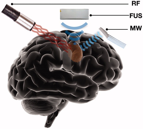 Figure 4. Schematic illustration summarizing some of the less common HT modalities that have been employed for brain tumor treatment. HT for brain tumors has been performed with ultrasound (US), radiofrequency (RF) and microwaves (MW).