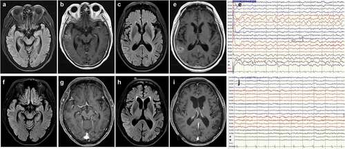 Figure 2. Post-COVID-19 vaccination encephalitis: magnetic resonance imaging (MRI) of the brain demonstrates prominent T2 fluid attenuated inversion recovery (FLAIR)-hyperintense lesions in the right middle temporal (a) and posterior temporal (c) regions with gadolinium enhancement (b, d). The EEG recordings exhibit intermittent focal slow waves in the right frontocentral to parietal regions (e). Post-treatment brain MRI (at 20 days after admission) shows attenuated signal intensity on the T2 FLAIR image (f, h), in the absence of enhancement in the middle-posterior temporal gyri (g, i). EEG findings were normal (j).