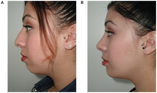 Figure 1 Before (A) and after (B) example of soft tissue augmentation with silastic chin onlay graft.