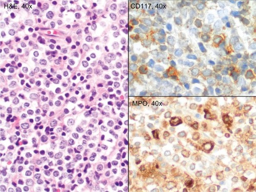 Figure 1 Biopsy of the nasopharyngeal mass, showing sheets of intermediate-sized blasts with round nuclei, dispersed chromatin, distinct nucleoli, and small amounts of cytoplasm. The tumor cells stained positive for myeloperoxidase and weakly for CD117.