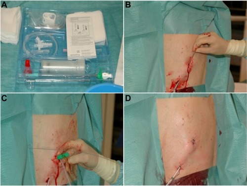 Figure 1 (A–D) A procedure has earlier been described by the group when implanting a permanent peritoneal PleurX catheter.Citation18Notes: The procedure is here briefly described for the implantation of a pleural PleurX catheter performed in local anesthesia (Xylocaine 1%) and under sterile conditions using the PleurX catheter kit (A). Two skin incisions are made, one medial for guide wire insertion and one ~5–8 cm lateral and caudal to the first incision for catheter exit. The fenestrated end of a 15.5-G pleural catheter is tunneled subcutaneously from the caudal lateral to the cranial medial incision crossing the costophrenic sulcus (B). Under US guidance, a J-Tip guide wire is inserted into the pleural space by an 18-G needle through the inferior incision. The needle is removed and a 16-G peel-away introducer is passed over the guide wire, and the guide wire is removed (C). The subcutaneously placed fenestrated end of the catheter is inserted into the peel-away introducer and further into the pleural space, and the peel-away introducer is removed. Both incisions are sutured. The catheter is sutured to the skin (D), connected to the catheter bag, and opened to ensure flow. Bandages are applied.