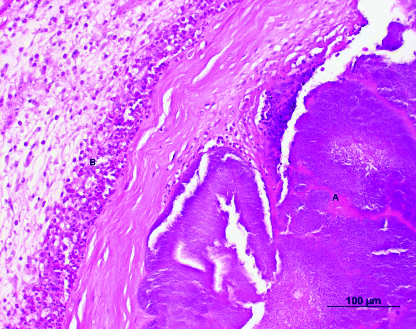 Figure 2.  Cross-section of the valvular region of the right ventricle of an Amazon parrot (A. autumnalis salvini) (haematoxylin and eosin stain). The thickened encocardium showed an inflammatory infiltrate consisting of granulocytic cells (B) and bacterial nests (A)