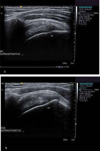 Figure 2. A and b. Ultrasound of both shoulders in a 48 year old female patient with unilateral subacromial pain syndrome.